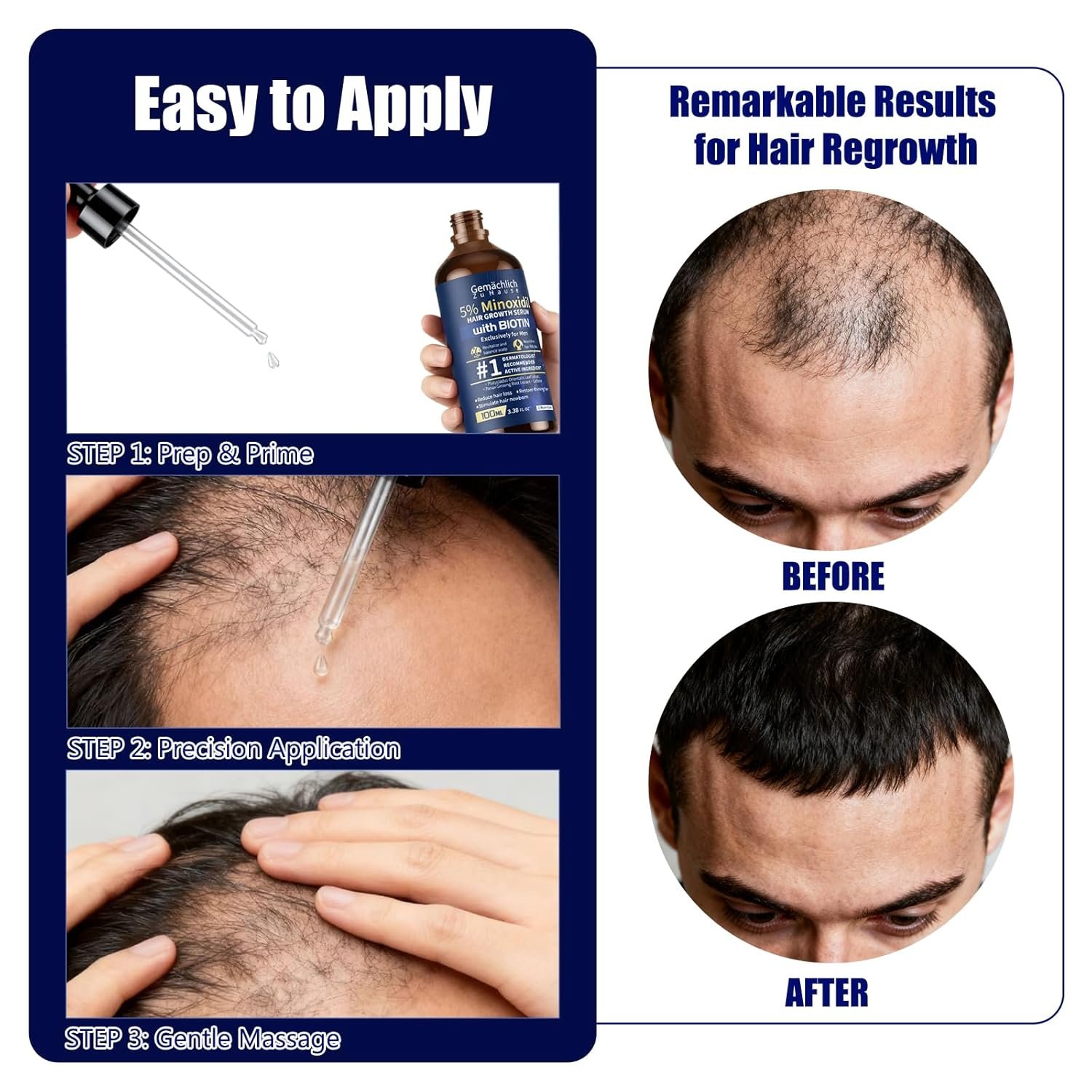 5%米诺地尔男性生发液 留学生宿舍镜前速效止脱 100ml生物素+迷迭香咖啡因精华 非油腻防秃再生 5%米诺地尔男性生发液 留学生宿舍镜前速效止脱 100ml生物素+迷迭香咖啡因精华 非油腻防秃再生