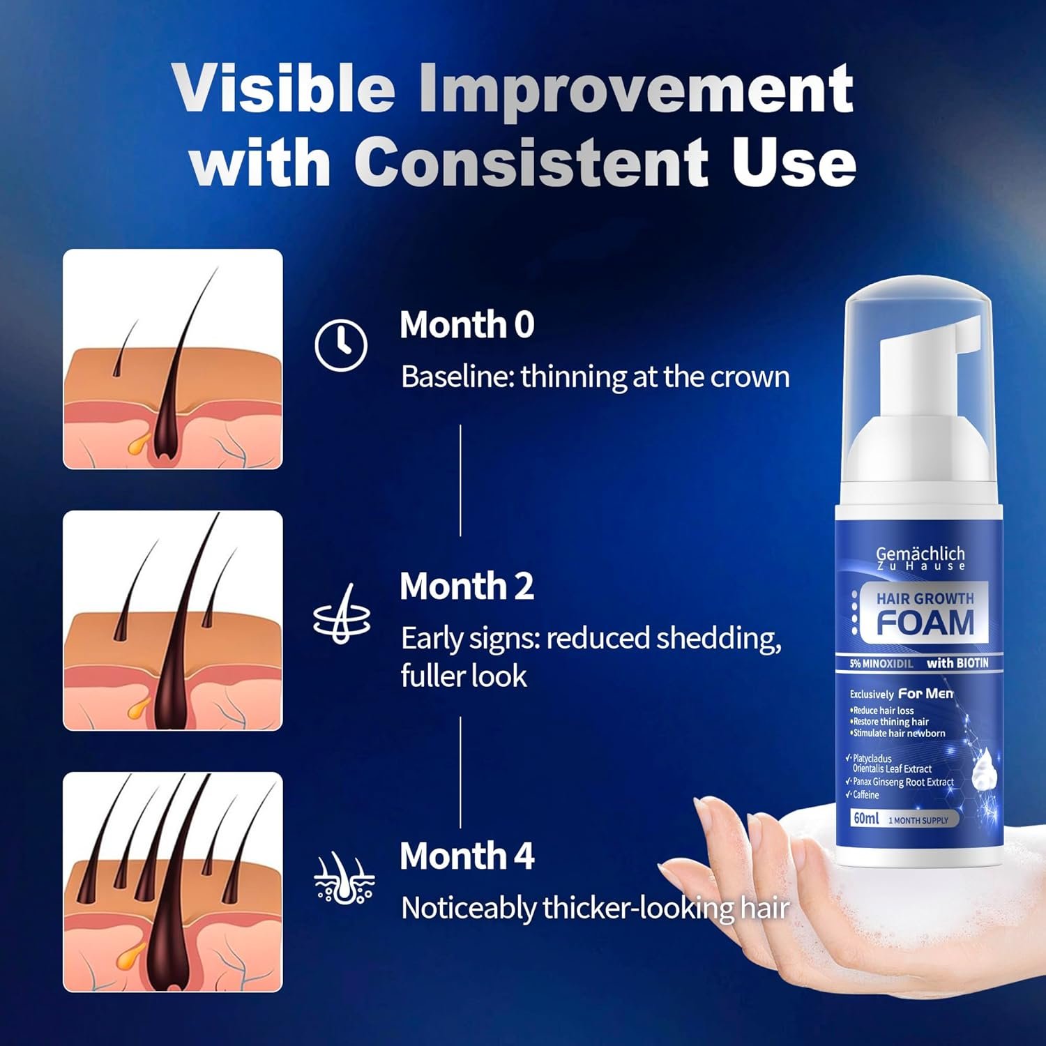 留学生宿舍镜前防脱方案：5%米诺地尔男性生发泡沫，生物素咖啡因迷迭香提取，防止稀疏增厚浓密发，非油腻60ml